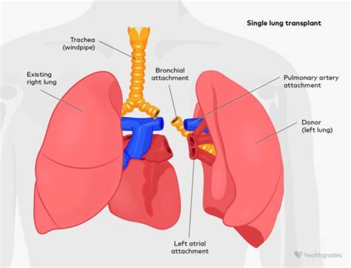 How do you get a lung transplant