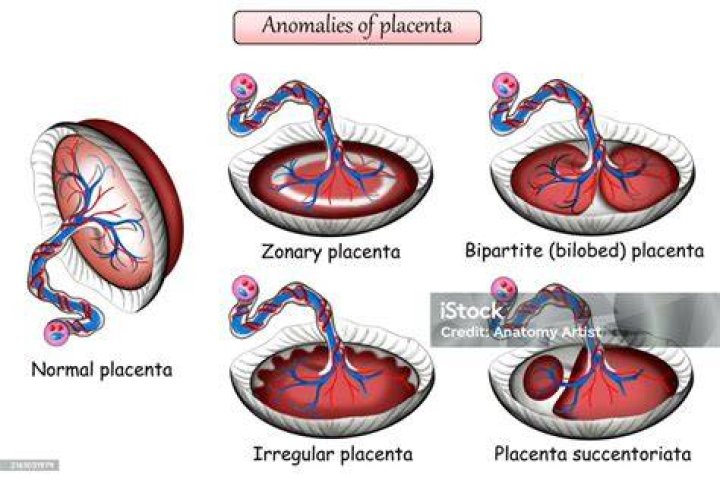 What causes Bilobed placenta