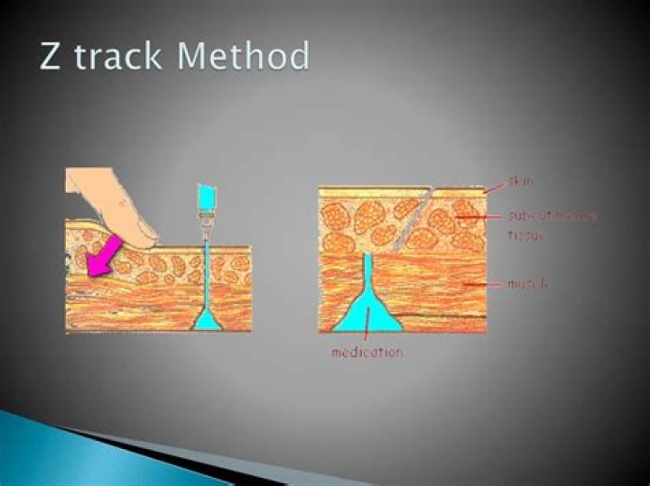 What is Z track method used for